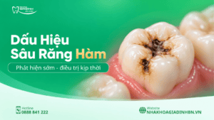 Sâu Răng Hàm: Dấu Hiệu, Khi Nào Trám Được Và Khi Nào Cần Chữa Tủy? 2 7 dấu hiệu sâu răng hàm thường gặp