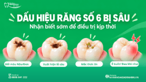 Sâu Răng Số 6: Dấu Hiệu, Có Trám Được Không Và Khi Nào Cần Chữa Tủy? 4 dâu hiệu răng số 6 bị sâu