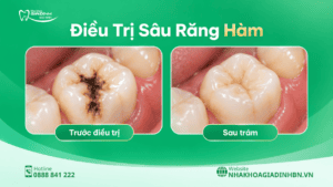Sâu Răng Hàm: Dấu Hiệu, Khi Nào Trám Được Và Khi Nào Cần Chữa Tủy? 5 rám sâu răng hàm trước và sau