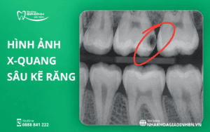 Sâu Kẽ Răng: Dấu Hiệu Khó Nhận Biết Và Cách Điều Trị 4 hình ảnh X-quang sâu kẽ răng