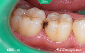 Sâu Kẽ Răng: Dấu Hiệu Khó Nhận Biết Và Cách Điều Trị 2 hình ảnh sâu kẽ răng hàm thực tế