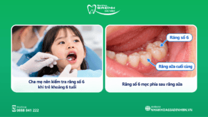 Sâu Răng Số 6: Dấu Hiệu, Có Trám Được Không Và Khi Nào Cần Chữa Tủy? 8 Sâu răng số 6 ở trẻ em: phụ huynh nên lưu ý điều gì?