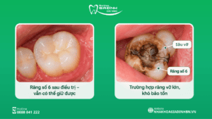 Sâu Răng Số 6: Dấu Hiệu, Có Trám Được Không Và Khi Nào Cần Chữa Tủy? 7 Răng số 6 bị sâu lỗ to có còn giữ được không hay phải nhổ?