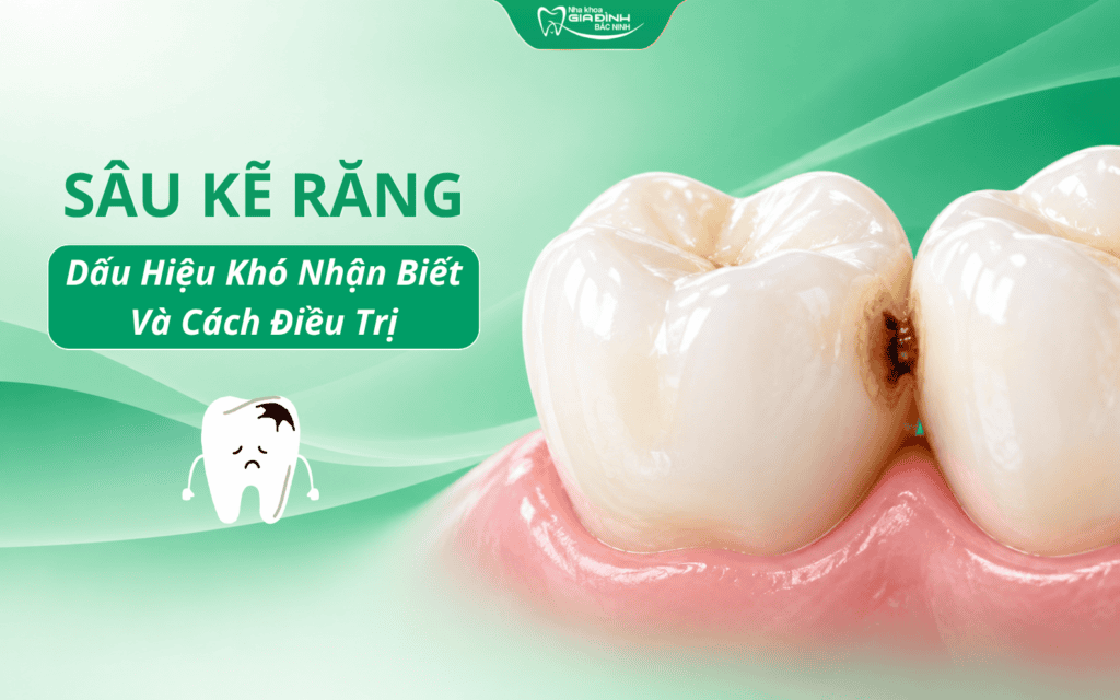 Sâu Kẽ Răng: Dấu Hiệu Khó Nhận Biết Và Cách Điều Trị 2 sau ke rang