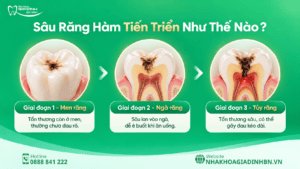 Sâu Răng Hàm: Dấu Hiệu, Khi Nào Trám Được Và Khi Nào Cần Chữa Tủy? 3 Sâu răng hàm tiến triển như thế nào?