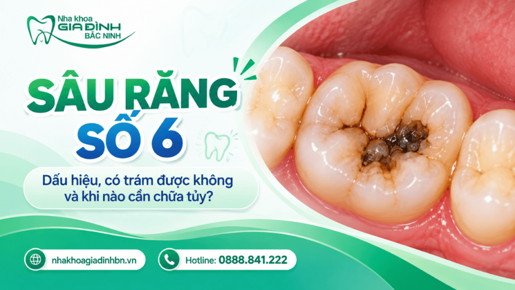 Sâu Răng Số 6: Dấu Hiệu, Có Trám Được Không Và Khi Nào Cần Chữa Tủy? 12 sau rang so 6