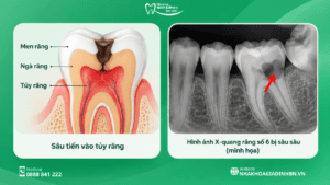 Sâu Răng Số 6: Dấu Hiệu, Có Trám Được Không Và Khi Nào Cần Chữa Tủy? 6 sâu răng số 6 có cần chữa tủy không