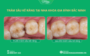 Sâu Kẽ Răng: Dấu Hiệu Khó Nhận Biết Và Cách Điều Trị 5 trám sâu kẽ răng trước và sau