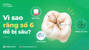 Sâu Răng Số 6: Dấu Hiệu, Có Trám Được Không Và Khi Nào Cần Chữa Tủy? 3 Vì sao răng số 6 dễ bị sâu?