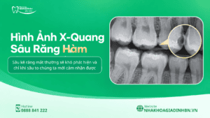 Sâu Răng Hàm: Dấu Hiệu, Khi Nào Trám Được Và Khi Nào Cần Chữa Tủy? 4 chụp film x quang sâu răng hàm