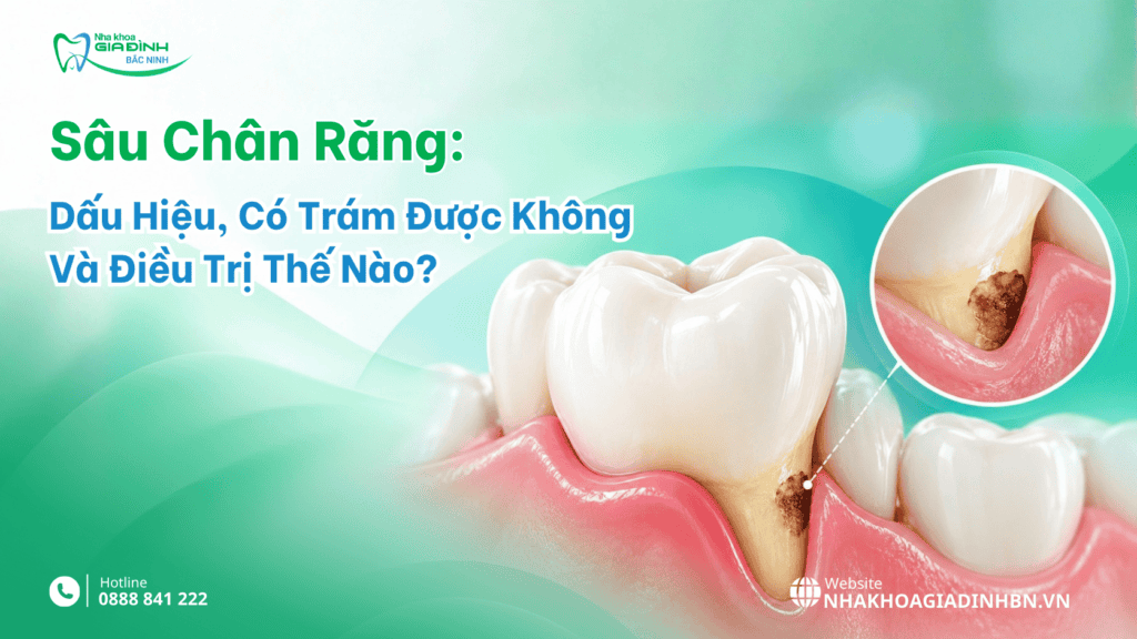 Sâu Chân Răng: Dấu Hiệu, Có Trám Được Không Và Điều Trị Thế Nào? 7 Sau chan rang 1