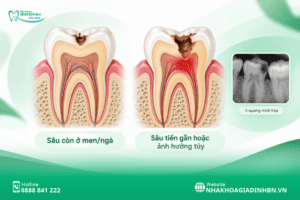 Khi nào sâu răng số 7 cần chữa tủy hoặc phải nhổ?