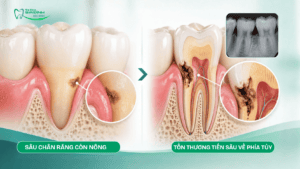Sâu Chân Răng: Dấu Hiệu, Có Trám Được Không Và Điều Trị Thế Nào? 3 muc do sau chan rang