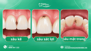 Sâu Răng Cửa: Dấu Hiệu, Có Trám Được Không Và Khi Nào Cần Chữa Tủy? 2 Sâu răng cửa là gì và thường xuất hiện ở đâu?