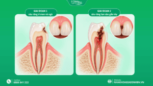Sâu Răng Cửa: Dấu Hiệu, Có Trám Được Không Và Khi Nào Cần Chữa Tủy? 3 Khi nào sâu răng cửa cần chữa tủy?