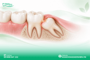Răng khôn có thể làm răng số 7 bị sâu