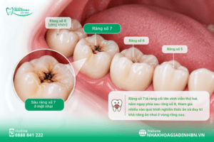 Sâu Răng Số 7: Dấu Hiệu, Có Trám Được Không Và Khi Nào Cần Chữa Tủy?