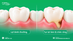 Sâu Chân Răng: Dấu Hiệu, Có Trám Được Không Và Điều Trị Thế Nào? 2 tut loi Sau chan rang